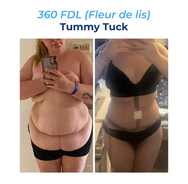 Before After-11