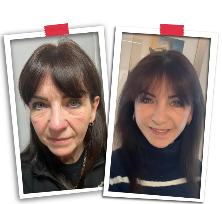 Facelift Before After-02
