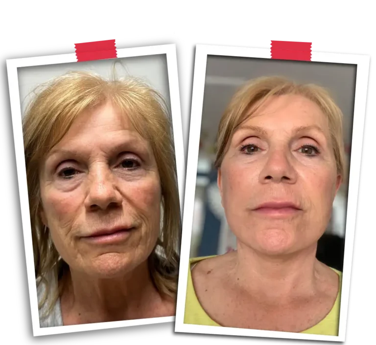Facelift Before After-08