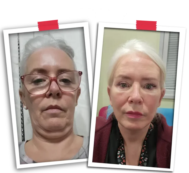 Facelift Before After-09