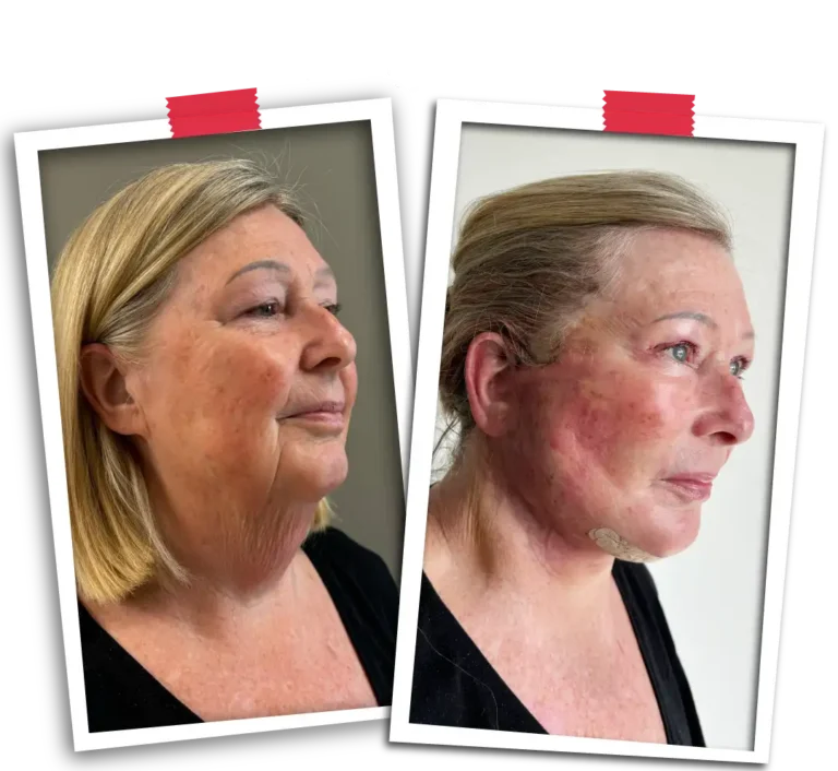 Facelift Before After-13