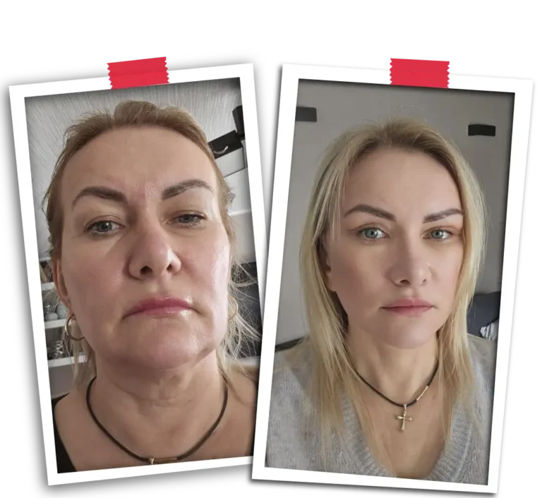 Facelift Before After-15