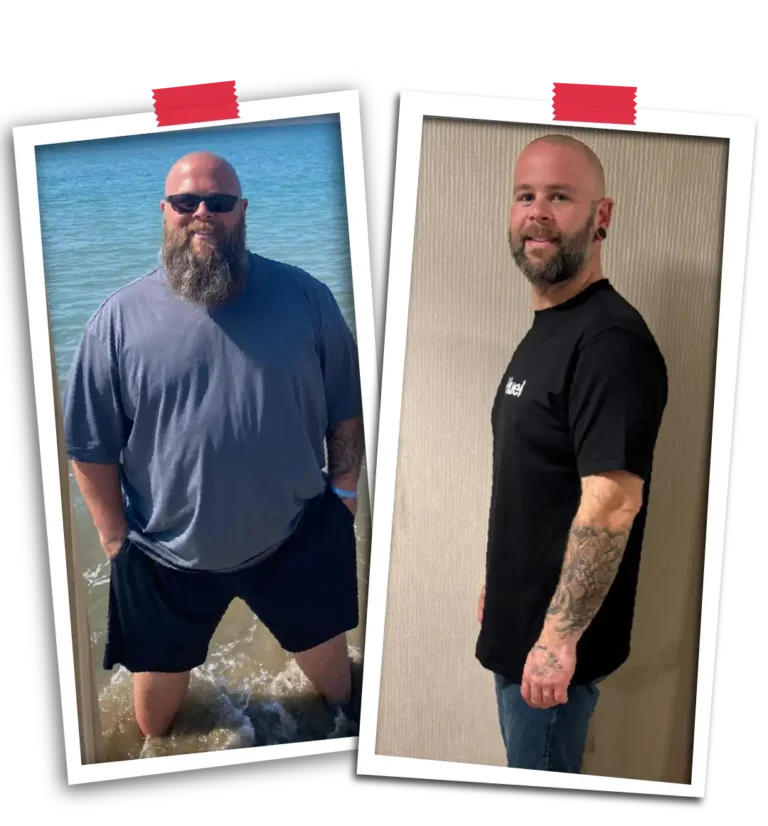 Bariatric Before After VP-07