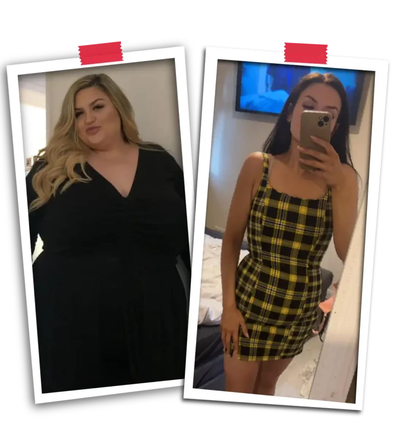 Bariatric Before After VP-10