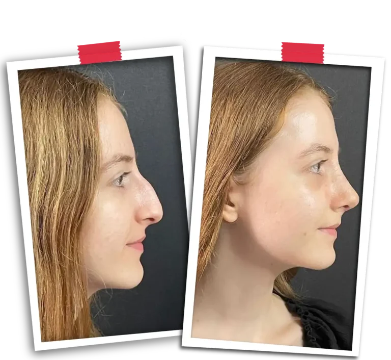 Rinoplasti Before After-01