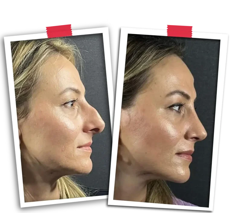Rinoplasti Before After-02