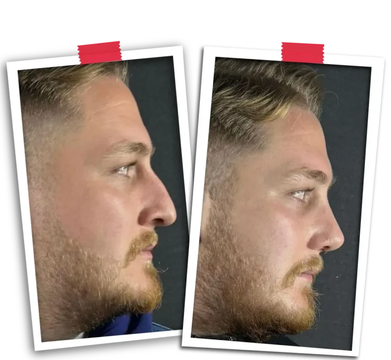 Rinoplasti Before After-04