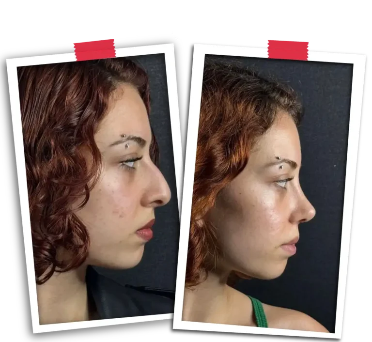 Rinoplasti Before After-05