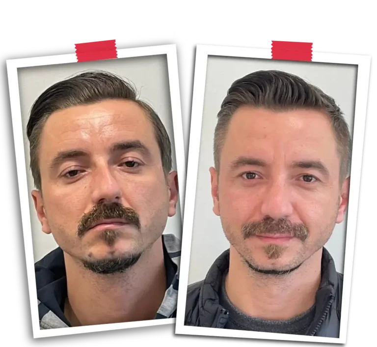 Rinoplasti Before After-09