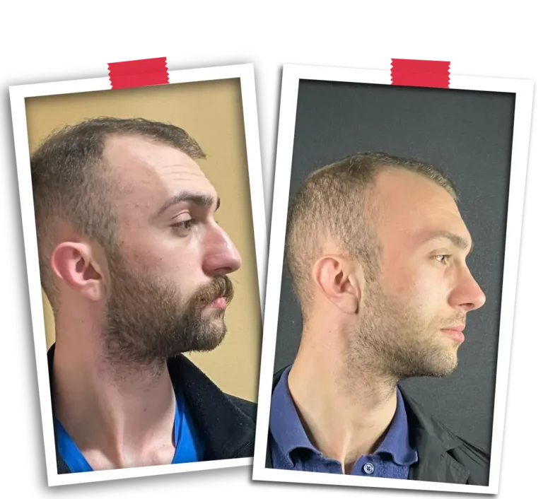 Rinoplasti Before After-10