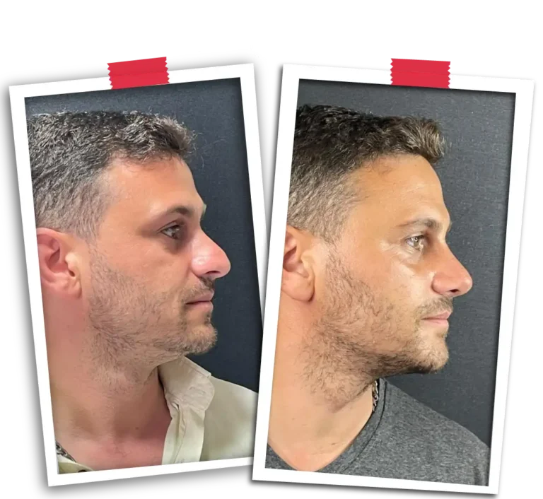 Rinoplasti Before After-11