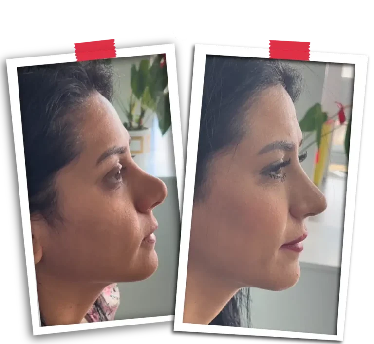 Rinoplasti Before After-14