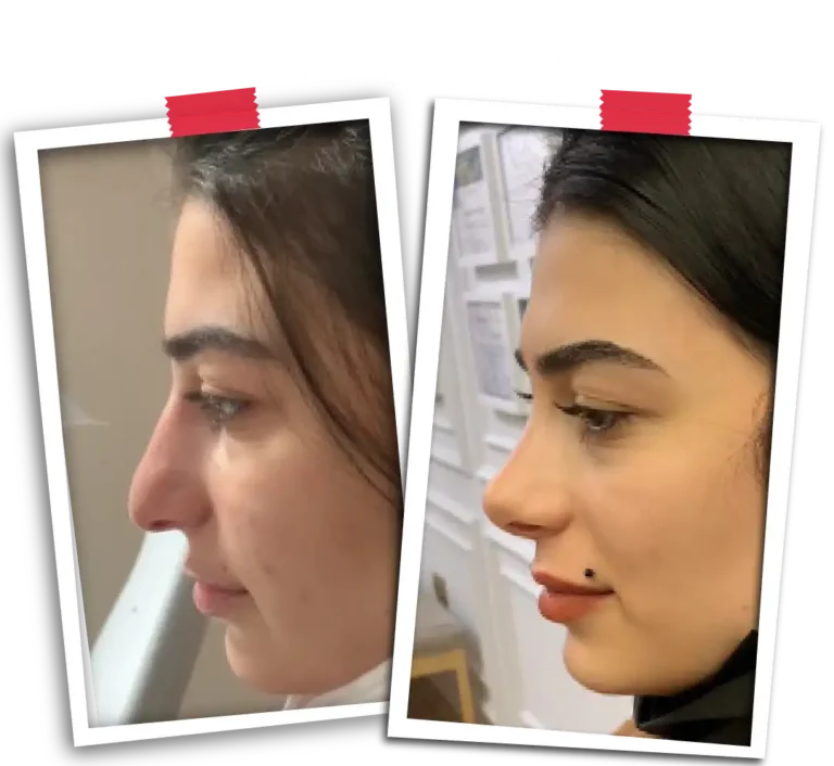 Rinoplasti Before After-15