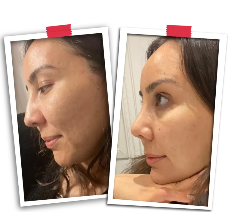 Rinoplasti Before After-16