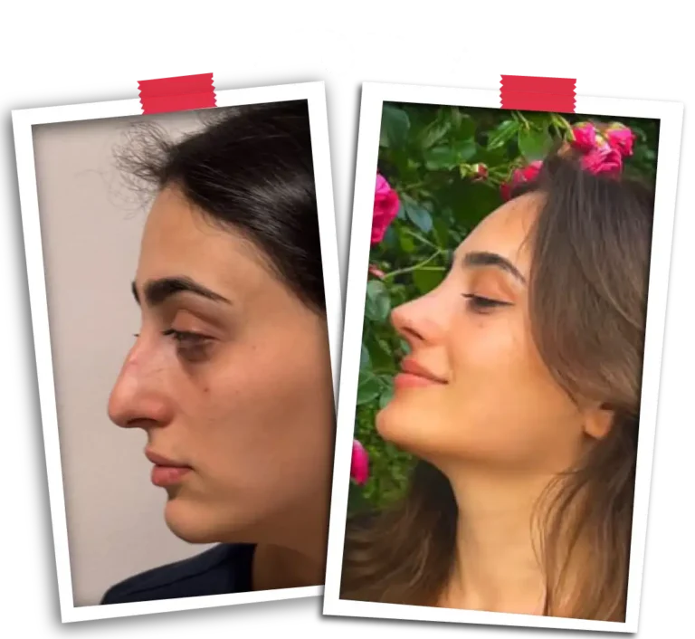 Septoplasty
