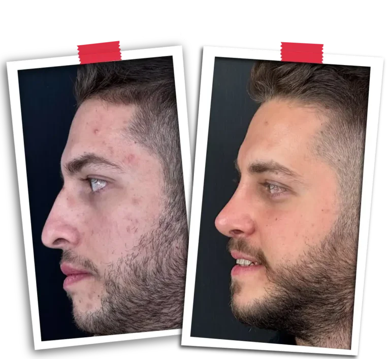 Rinoplasti Before After-18