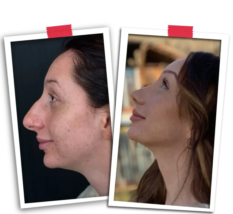 Revision Rhinoplasty