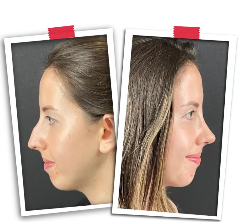 Rhinoplasty