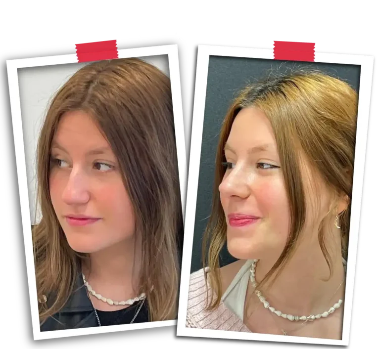 rhinoplasty