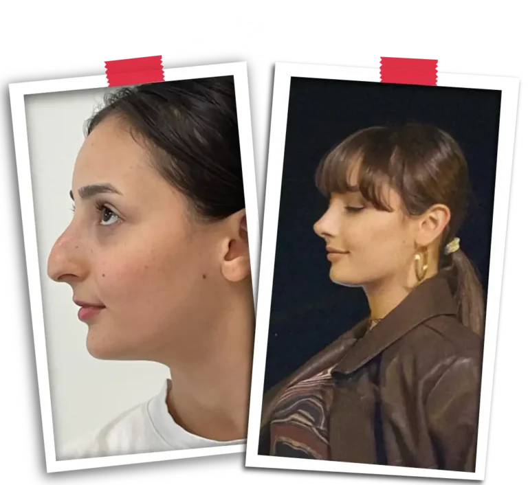 rhinoplasty