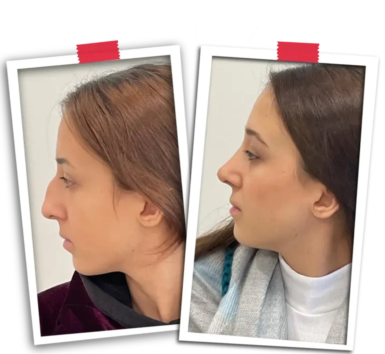 Rhinoplasty