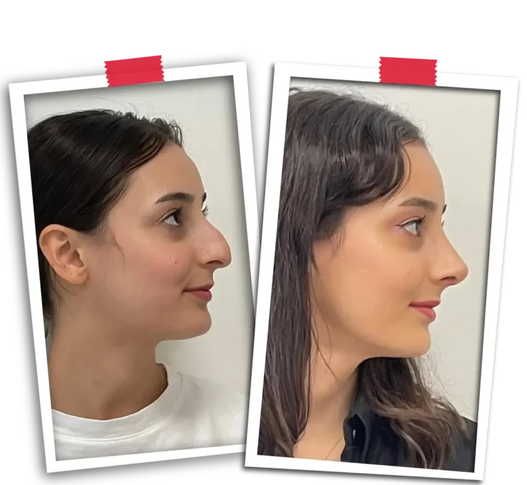 Rhinoplasty