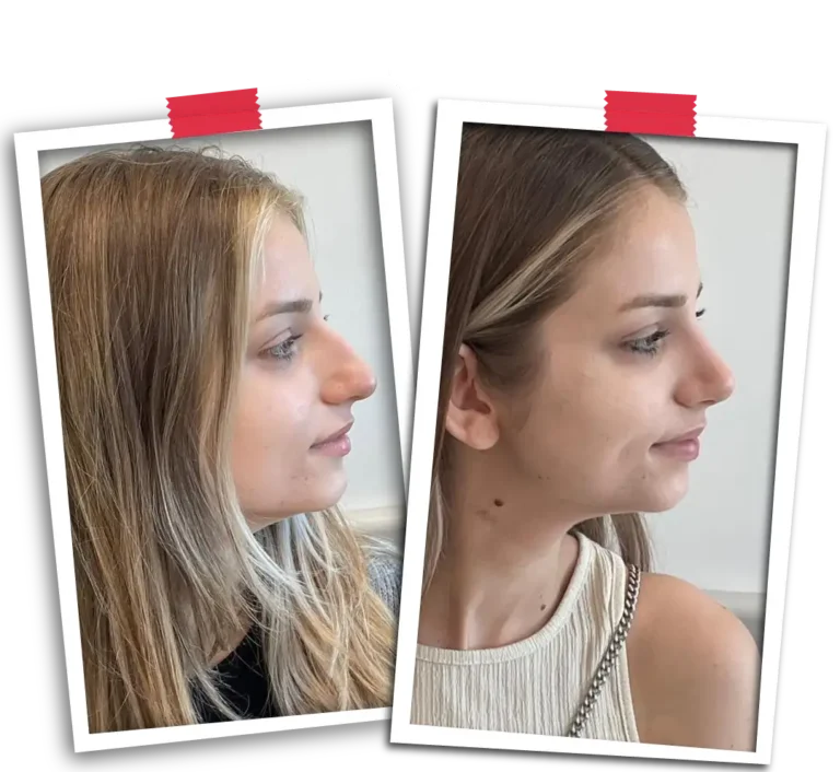 Rhinoplasty