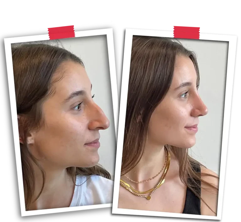 Rhinoplasty