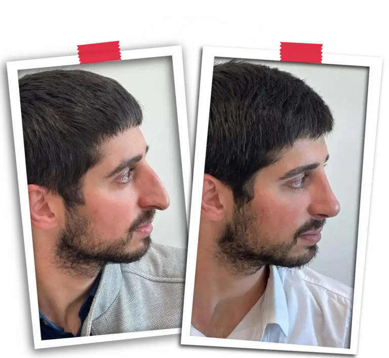 Rhinoplasty