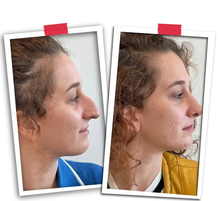 Rhinoplasty Before After
