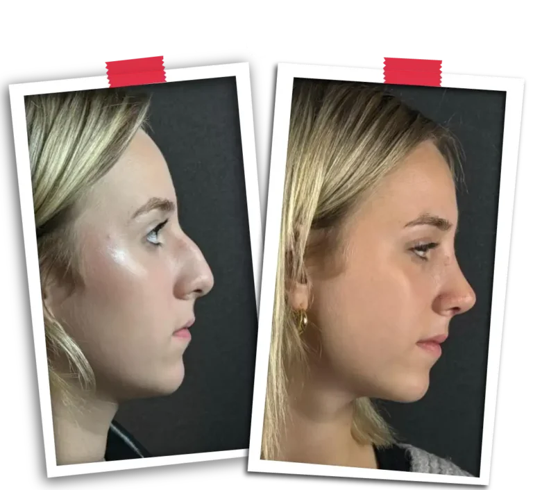 Rinoplasti Before After VP-06