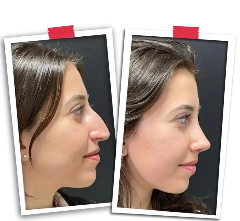 Rinoplasti Before After VP-07