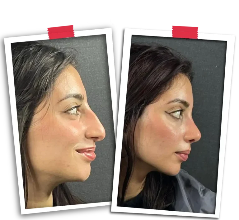 Rinoplasti Before After VP-08