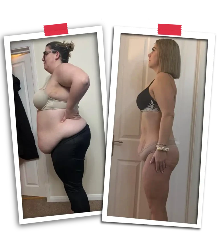 Bariatric Before After 2026-27