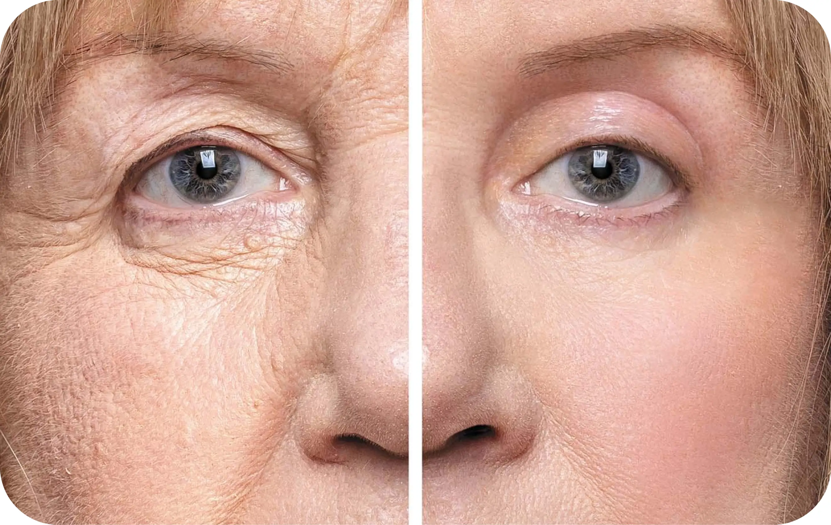 Blepharoplasty