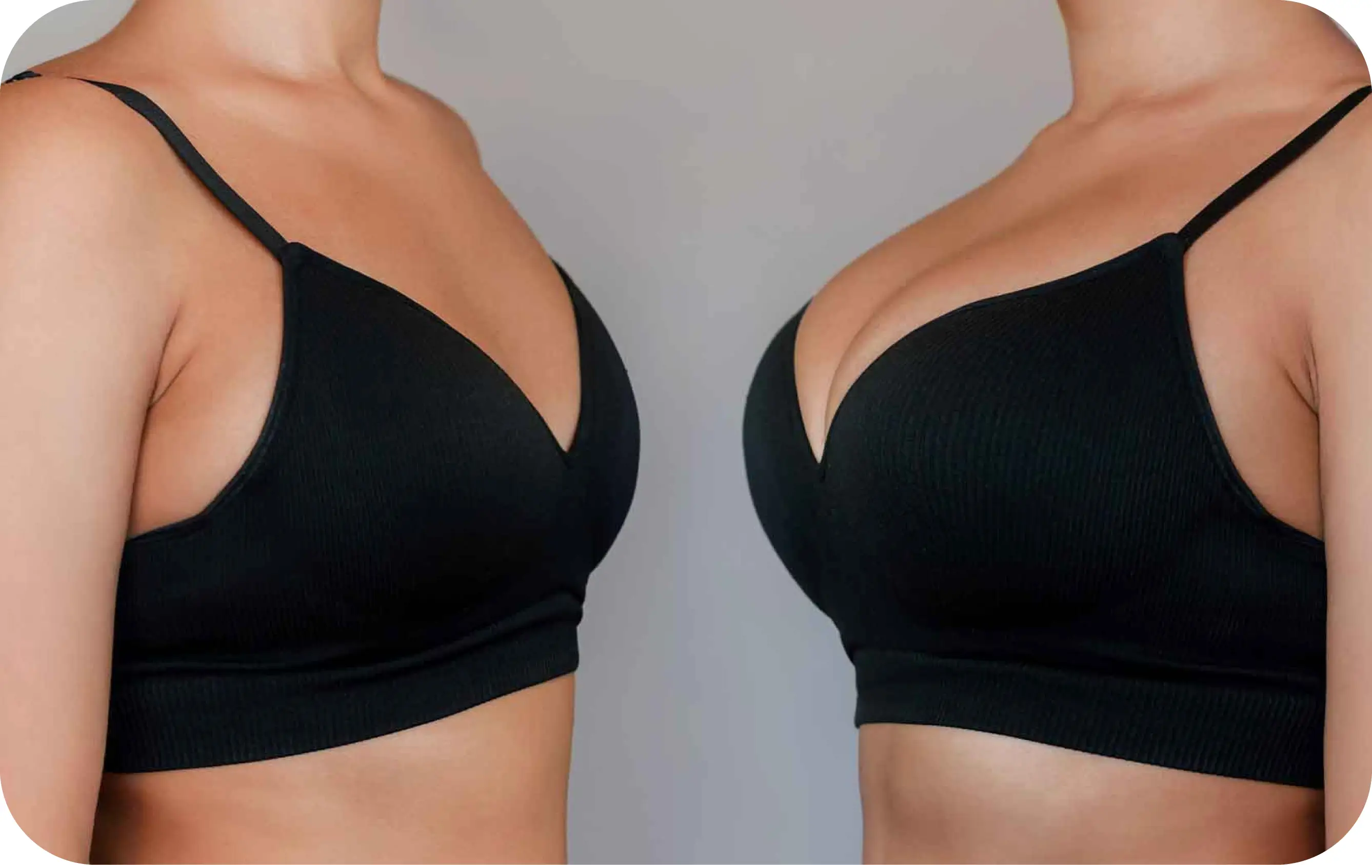 Breast Implant