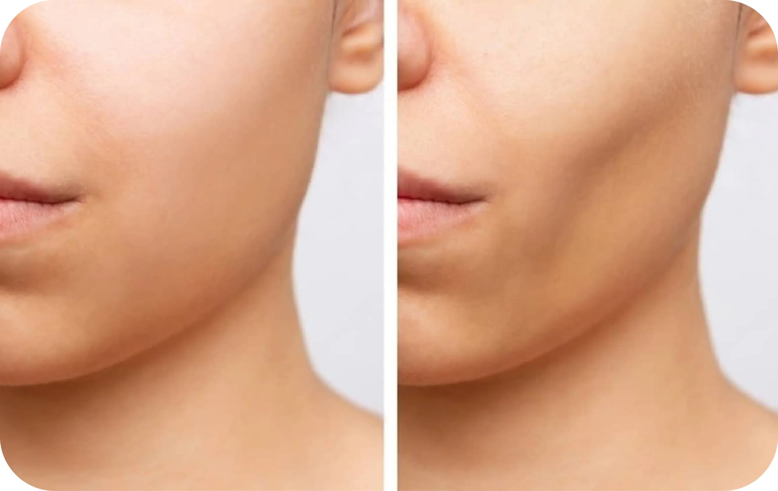 Buccal Fat Removal
