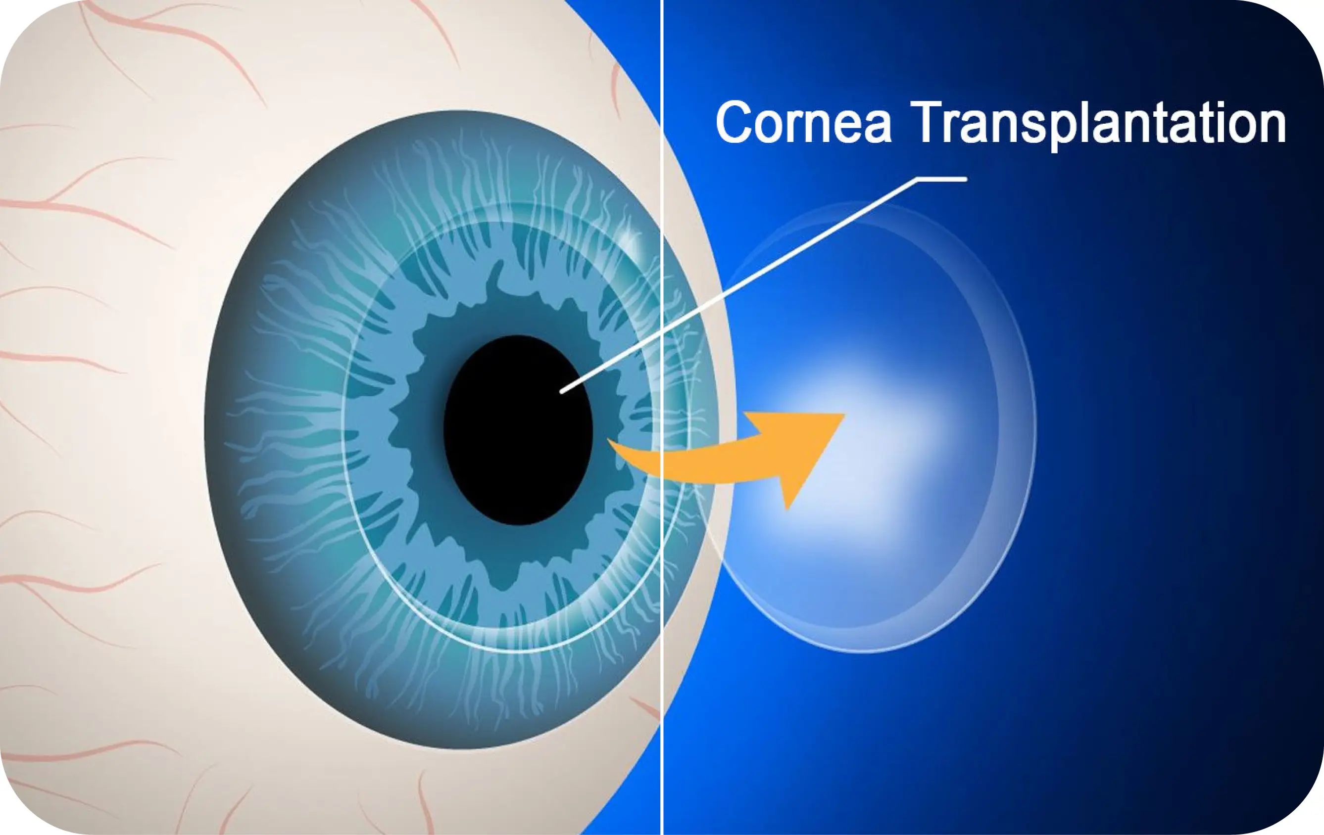 Cornea Transplantation