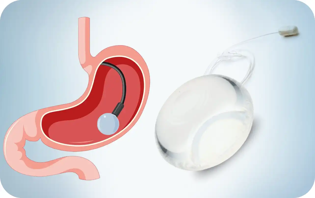 Gastric Balloon & Allurion Swallowable