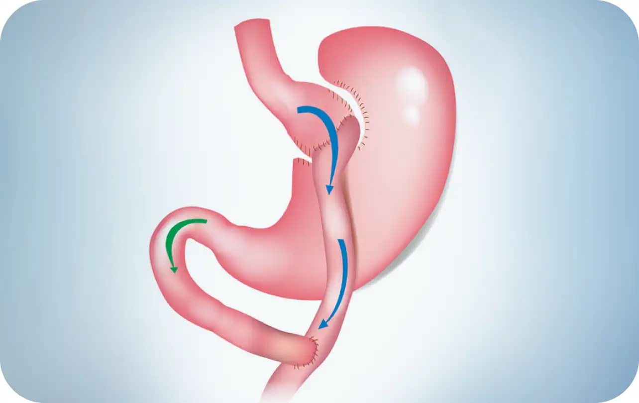 Roux En Y Gastric Bypass