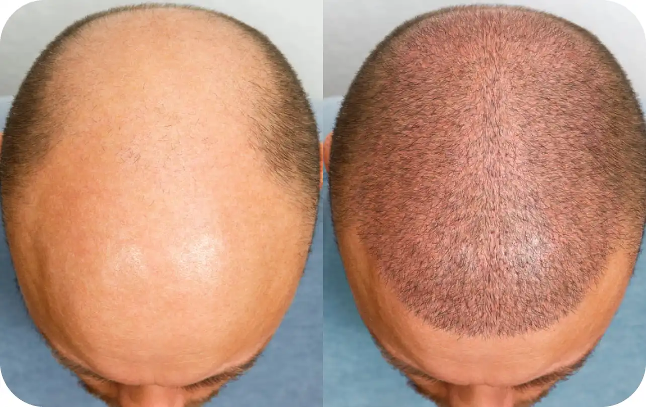 Hair Transplant