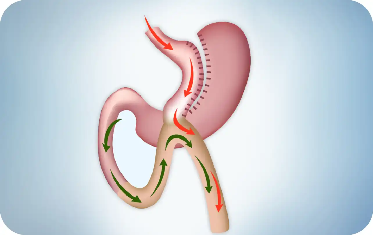 Mini Gastric Bypass