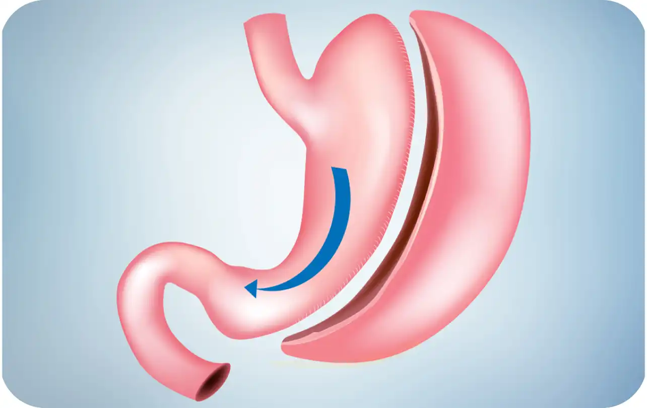 Gastric Sleeve