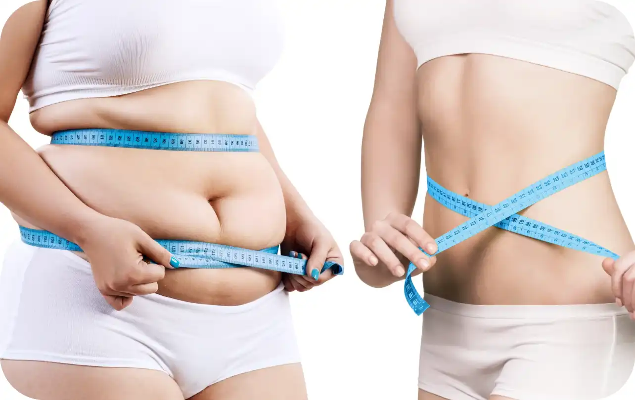 Bariatric Surgery