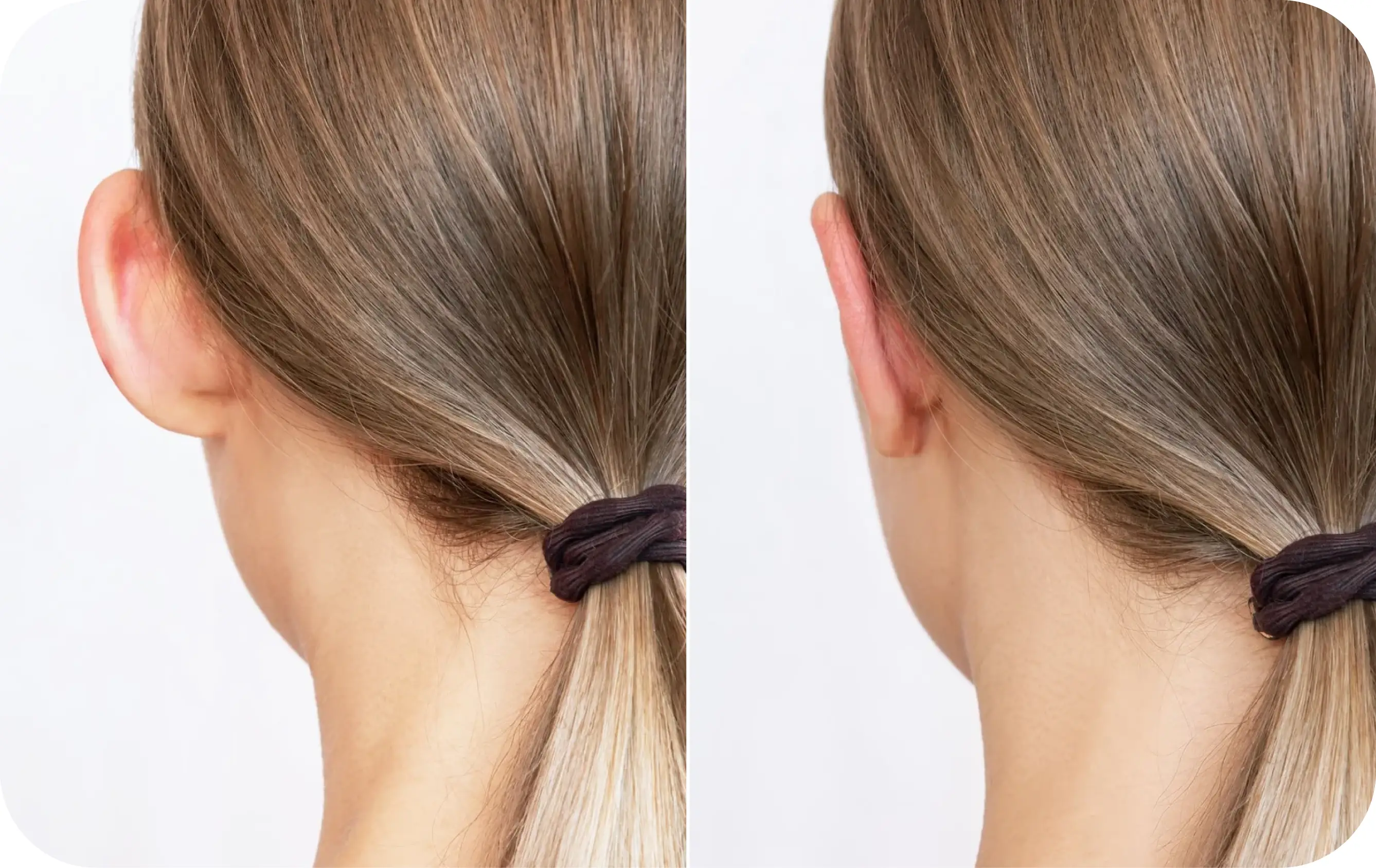 Ear Correction