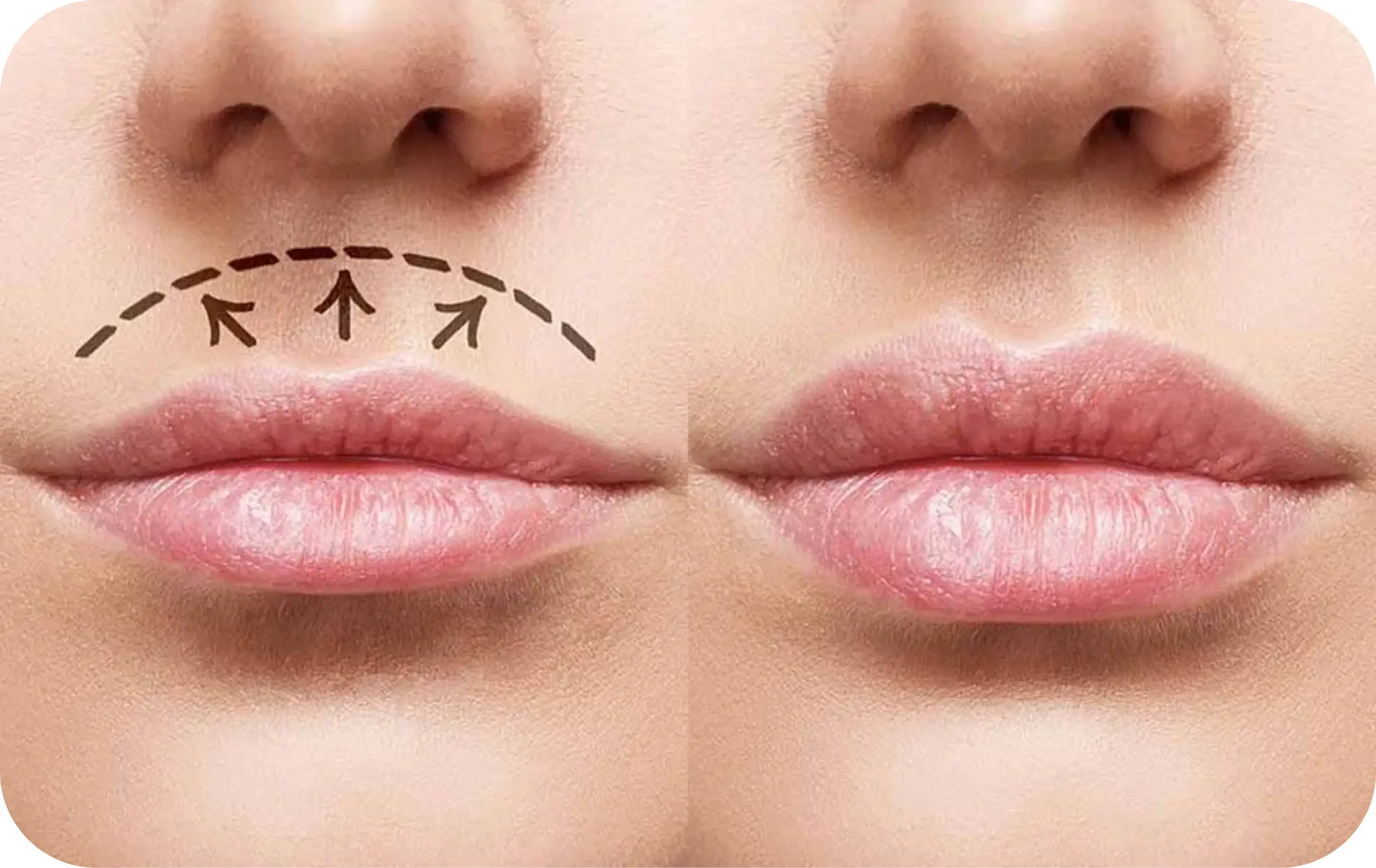 Lip Lift