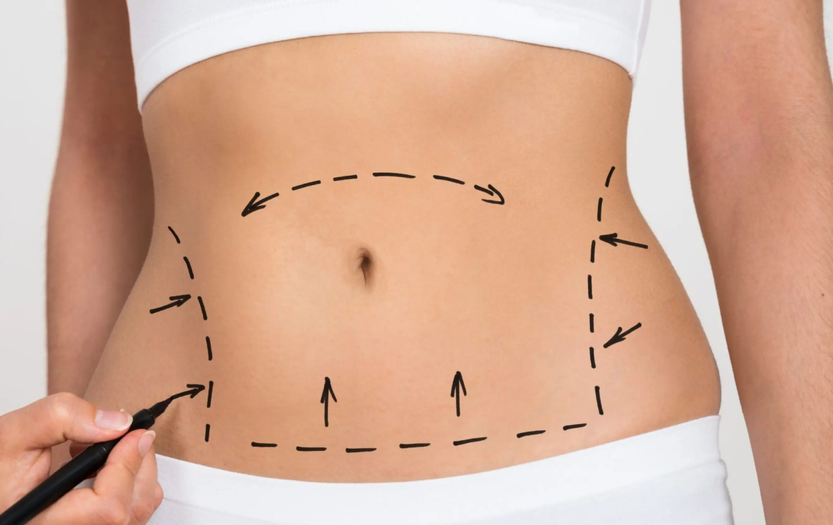 Liposuction