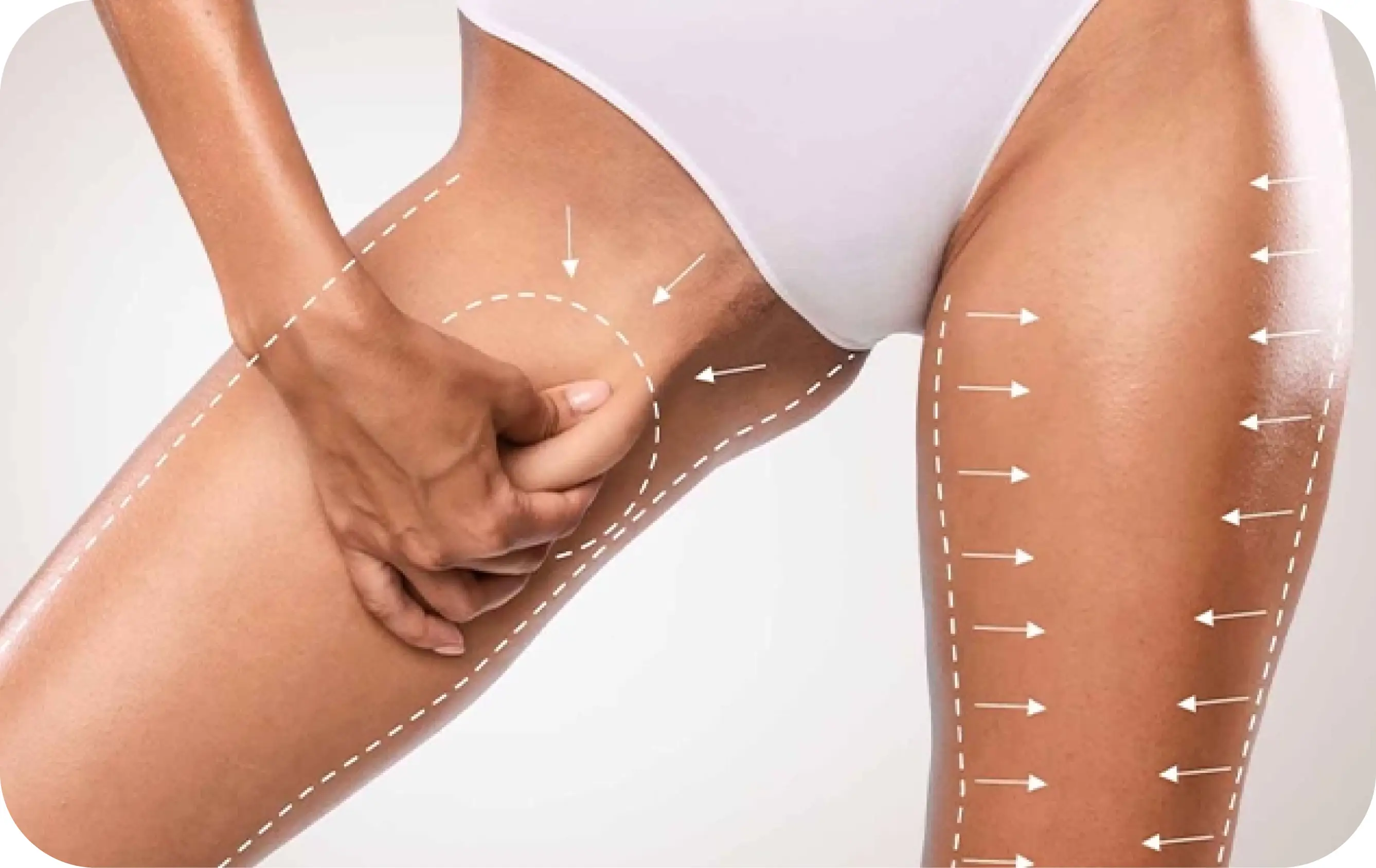 Thigh Lift